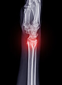 Fractured ulna, X-ray