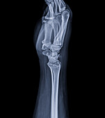 Healthy wrist, X-ray