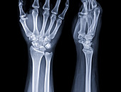 Healthy wrist, X-rays