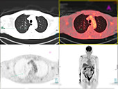 Recurrance of cancer after surgery, PET and CT scans