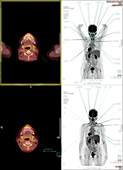 Recurrance of cancer after surgery, PET and CT scans