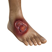 Buruli ulcer on a foot, illustration