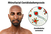 Rhinofacial conidiobolomycosis and fungus, illustration