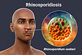 Nasal rhinosporidiosis, illustration