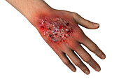 Protothecosis infection on a human hand, illustration