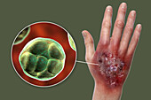 Protothecosis infection on a human hand, illustration