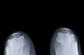 Healthy knees, X-ray