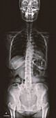 Scoliosis of the spine, X-ray