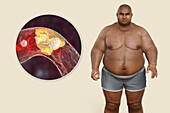 Obesity and atherosclerosis, conceptual illustration