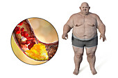 Obesity and atherosclerosis, conceptual illustration