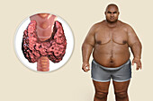 Thyroid diseases and obesity, conceptual illustration