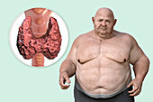 Thyroid diseases and obesity, conceptual illustration