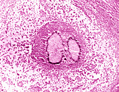 Madurella grisea fungal infection, light micrograph