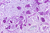 Pneumocystis jirovecii fungus in lung tissue, light micrograph