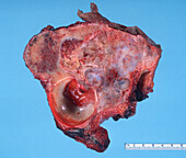 Chondrosarcoma of the pelvis