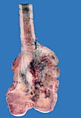 Osteosarcoma of the thigh bone