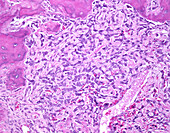 Osteoblastic osteosarcoma, light micrograph