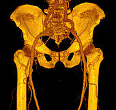 Iliac arteries, CT scan