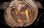 Pulmonary artery, CT scan