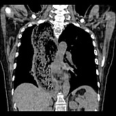 Achalasia of the oesophagus, CT scan