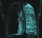Pulmonary giant bulla, CT scan