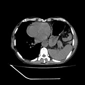 Hiatus hernia, CT scan