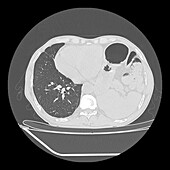 Hiatus hernia, CT scan