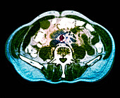 Atherosclerosis, CT scan
