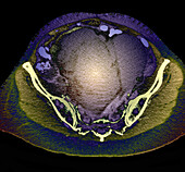 Pelvic tumour, CT scan