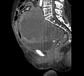 Pelvic tumour, CT scan