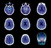 Parkinson's disease electrode implants, CT scans