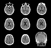 Parkinson's disease electrode implants, CT scans