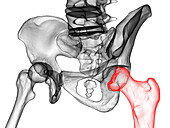 Legg-Calve-Perthes disease, illustration