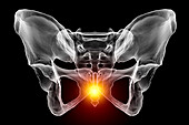 Coccyx pain, conceptual illustration