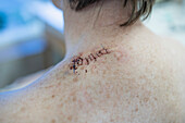 Medizinische Nähte im Rücken einer Frau nach einer Operation