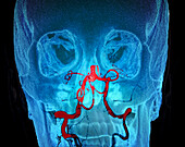 Ischaemic stroke, CT scan