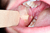 Oral ulcer