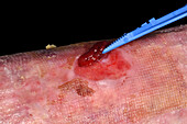 Haematoma removal