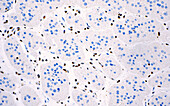 BAP-1 protein loss, light micrograph