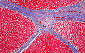 Liver cirrhosis, light micrograph