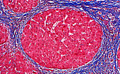 Liver cirrhosis nodule, light micrograph