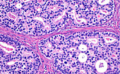 Prostate cancer cribriform pattern, light micrograph
