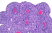 Papillary bladder cancer, light micrograph