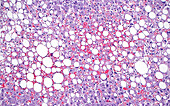 Fatty liver disease, light micrograph