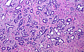 Prostate gland atrophy, light micrograph