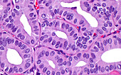 Thyroid papillary cancer, light micrograph