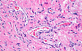 Solitary fibrous tumour vessels, light micrograph