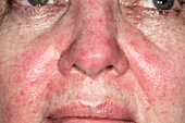 Acne rosacea