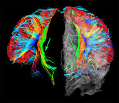 Primary somatosensory nerve fibres, DTI MRI scan