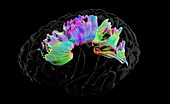 Corpus callosum, DTI MRI scan